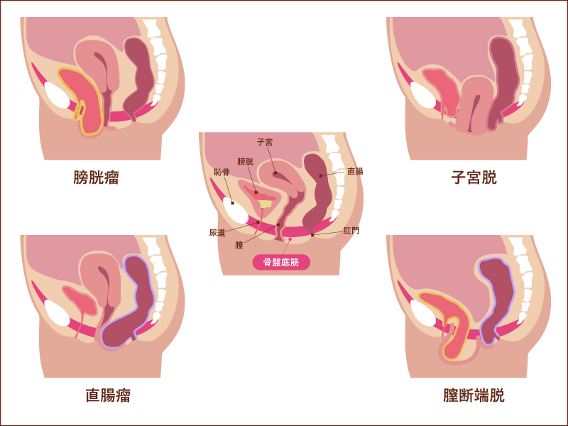 骨盤臓器脱について